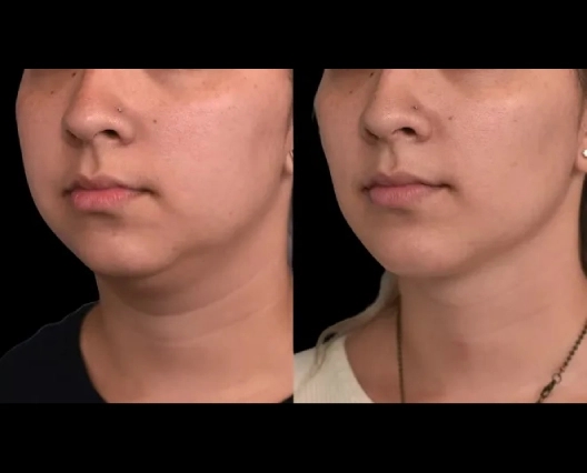 Double Chin Removal for Different Face Shapes: What the Best Double chin removal Surgeons in dubai Say