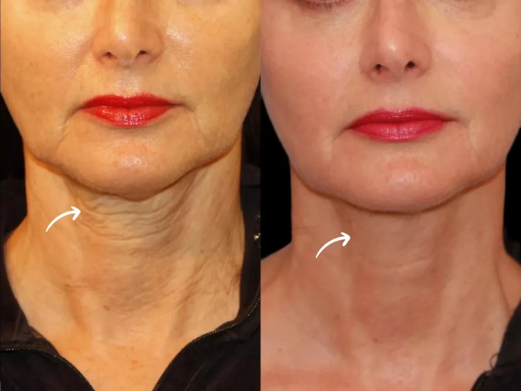 Best Doctors in dubai Recommend Sculptra for Long-Term Skin Health